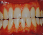 Beter laser teeth whiening by southpattayadental