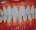 after laser teeth whiening by southpattayadental